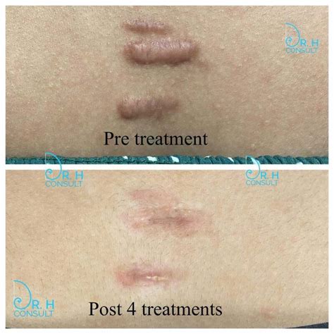 Surgical keloid scar removal