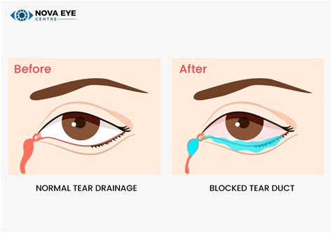 surgical options for clogged eye duct