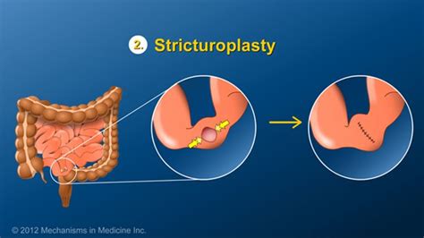 surgical treatment of small bowel obstruction