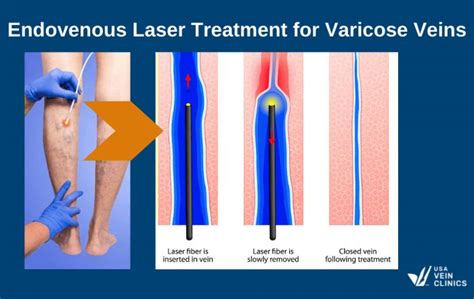 surgical varicose vein removal