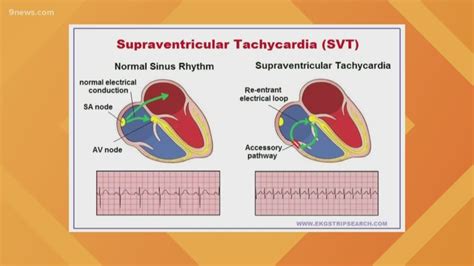 SVT Treatment