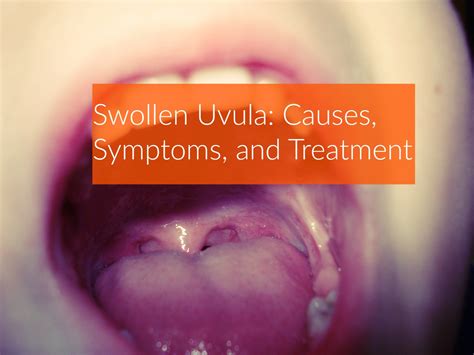 swollen uvula