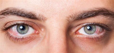 Symptom 5: Eye Infections