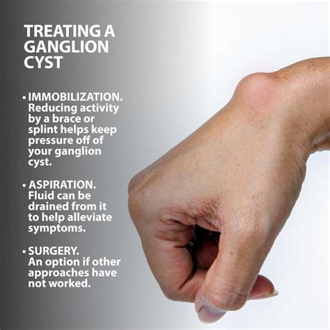 symptoms of ganglion cysts