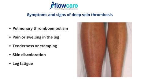 Symptoms of Leg Vein Thrombosis