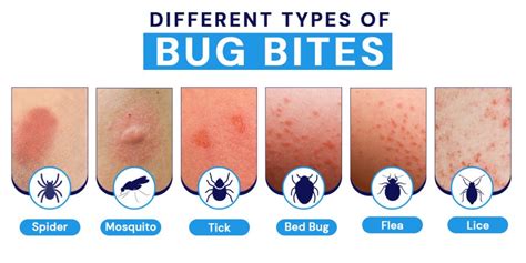 Symptoms of Bite and Sting Swelling