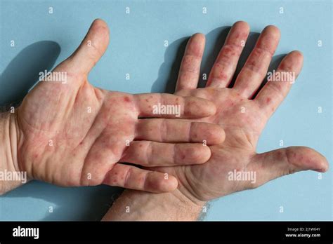 Symptoms of blisters on hands
