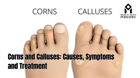 Symptoms of Calluses
