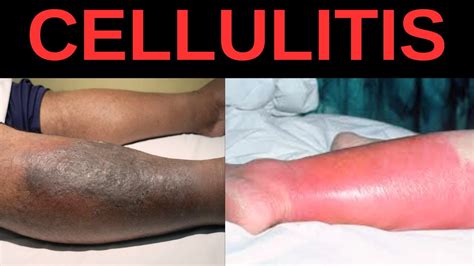 Symptoms of Cellulitis