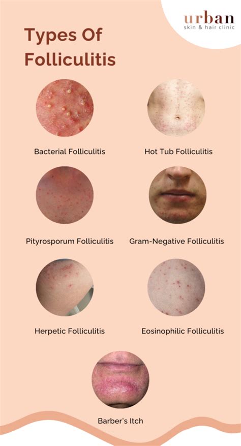 symptoms of folliculitis