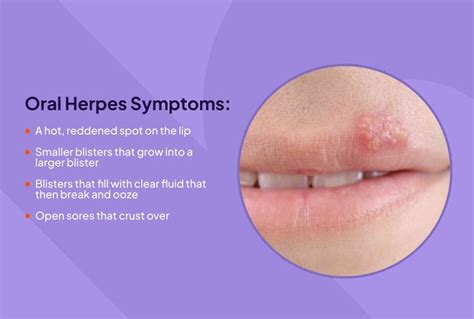 Symptoms of Herpes on Hand