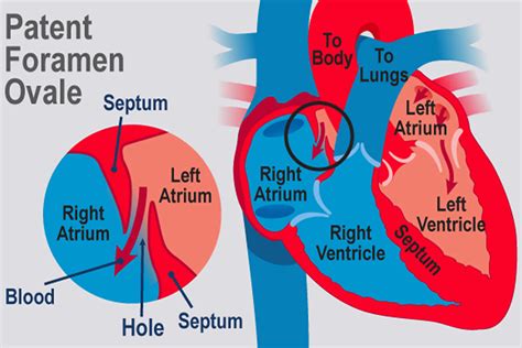 Symptoms of PFO