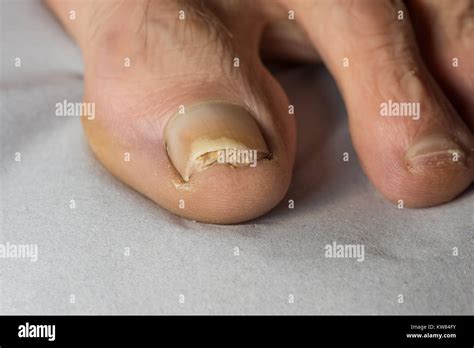 symptoms of toe nail bed pain