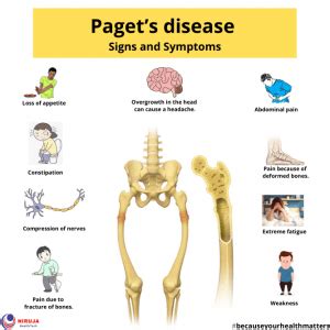 Symptoms of Paget's disease