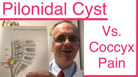 tailbone cysts