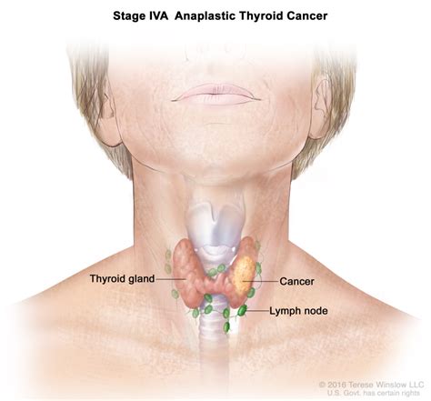 Tender Lymph Nodes and Cancer