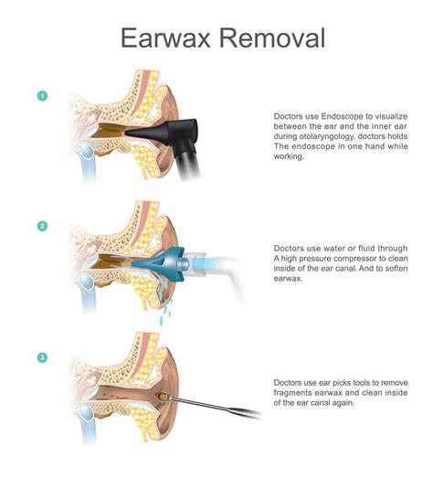 The Benefits of Earwax Removal