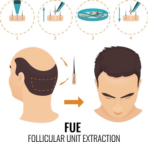 The Hair Transplantation Process