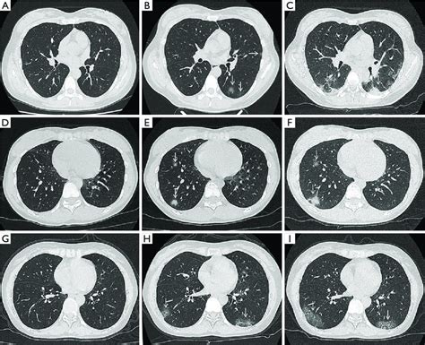 Thoracic CT Scan