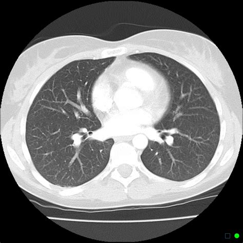Thoracic CT Scan Next Steps