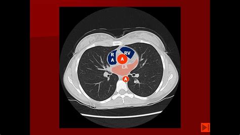 Thoracic CT Scan Tips