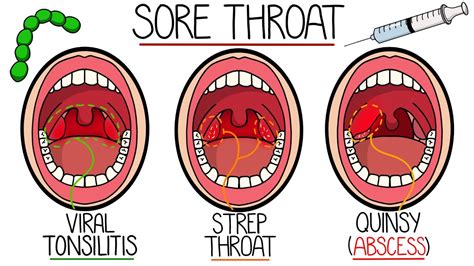 Throat Abscess