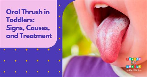 Thrush in baby symptoms