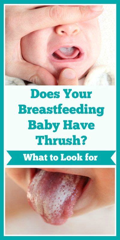 Thrush in infants and breastfeeding