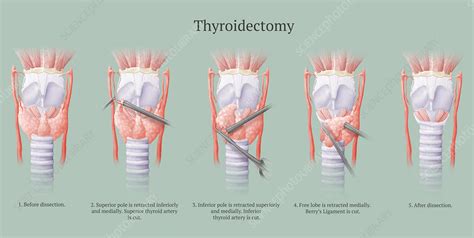 Preparation for thyroidectomy