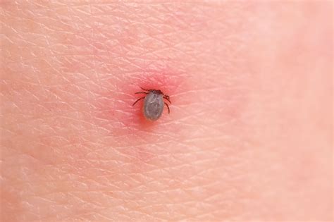 tick bite