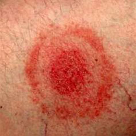 Tick Bite Rash