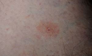 Tick Bite Rash Causes