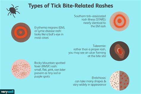 Tick Bite Rash Conclusion