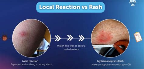 Tick Bite Reactions