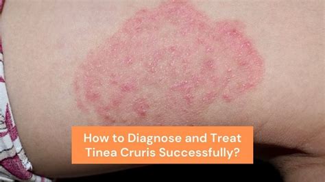tinea cruris causes