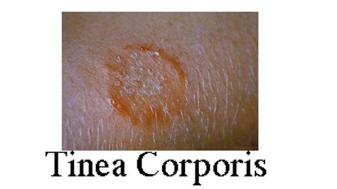 tinea cruris complications