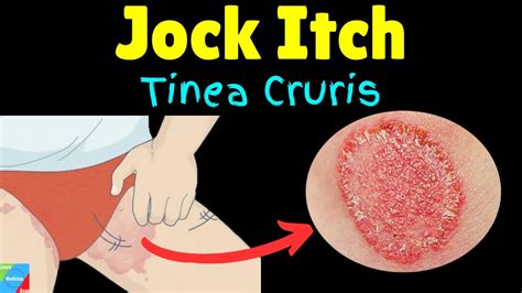 tinea cruris conclusion
