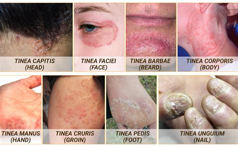 tinea cruris treatment