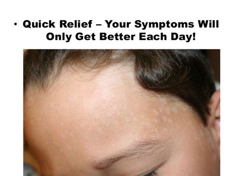 Tinea Flava Treatment Options