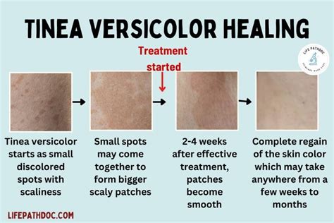 tinea versicolor causes