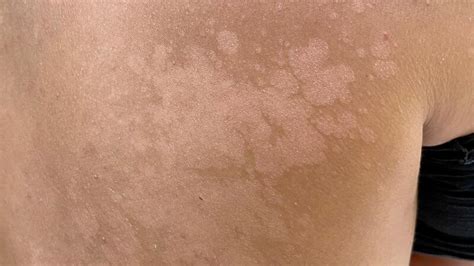 tinea versicolor skin health