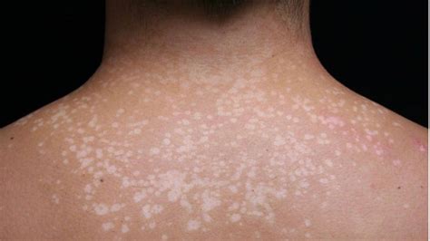 tinea versicolor symptoms