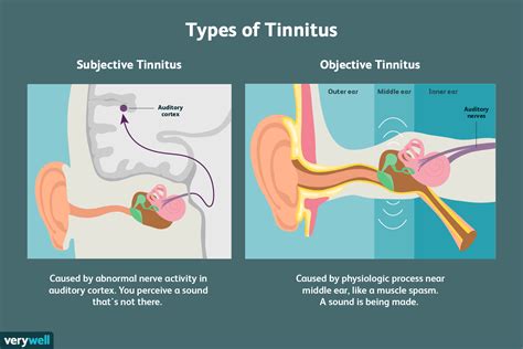 Tinnitus Causes