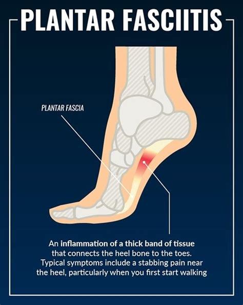 Tips for Preventing Plantar Fasciitis
