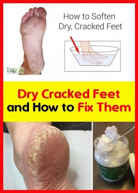 tips to fix cracked feet