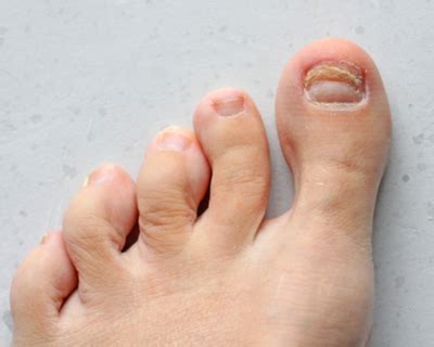toe nail bed pain