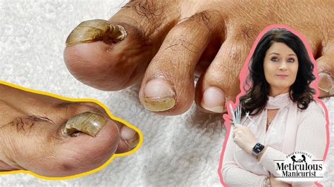 toenail detachment