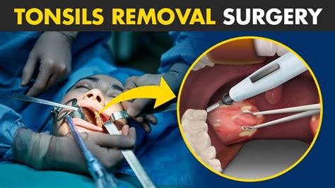tonsil removal
