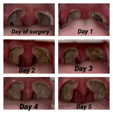 Tonsil removal recovery process