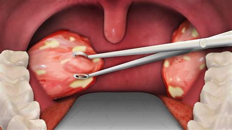 Tonsil removal surgery benefits and risks